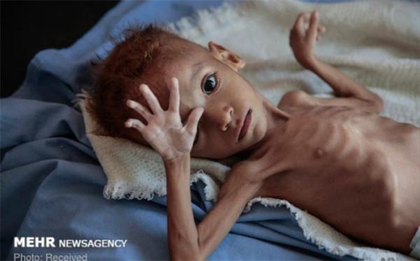 75 درصد بچه ها یمنی از سوء تغذیه حاد رنج می برند